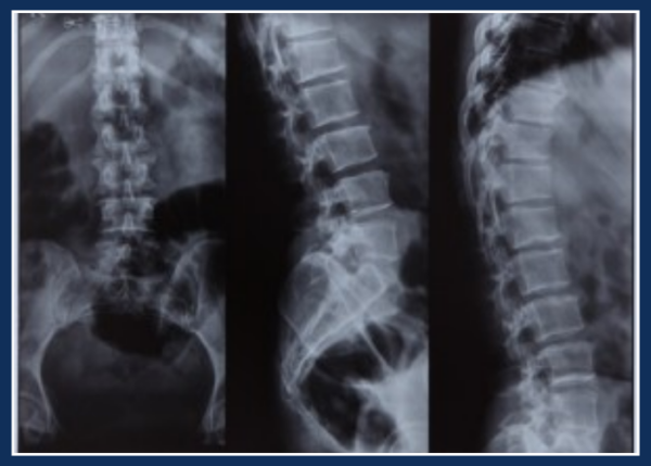 Colonna Vertebrale